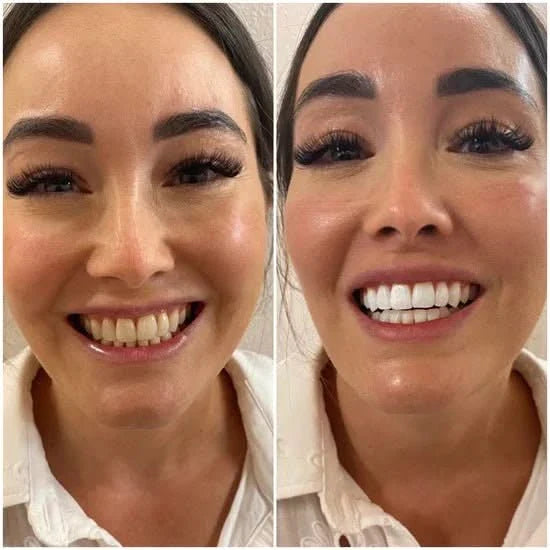 HaloSmile Max